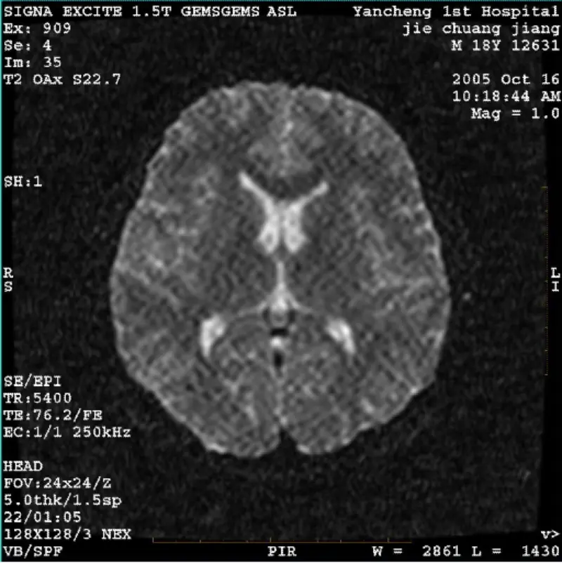 ARTIFACT WI/Fiesta Görüntüsü Beyaz Piksel